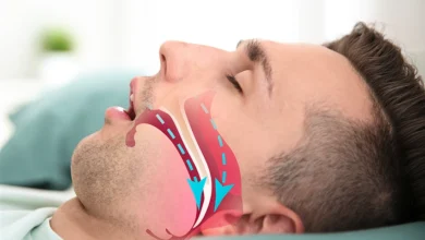 Can You Have Sleep Apnea Without Tonsils